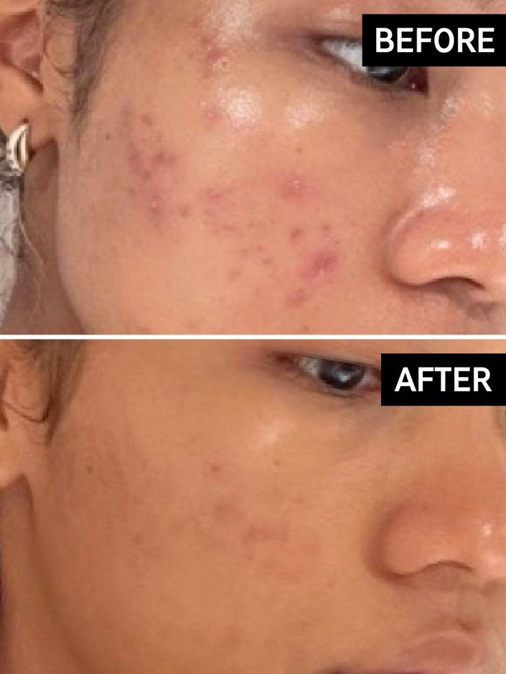 Eelhoe Dark Spot Correcting Glow Serum & Hoygi Niacinamide 10%+TXA 3% Serum